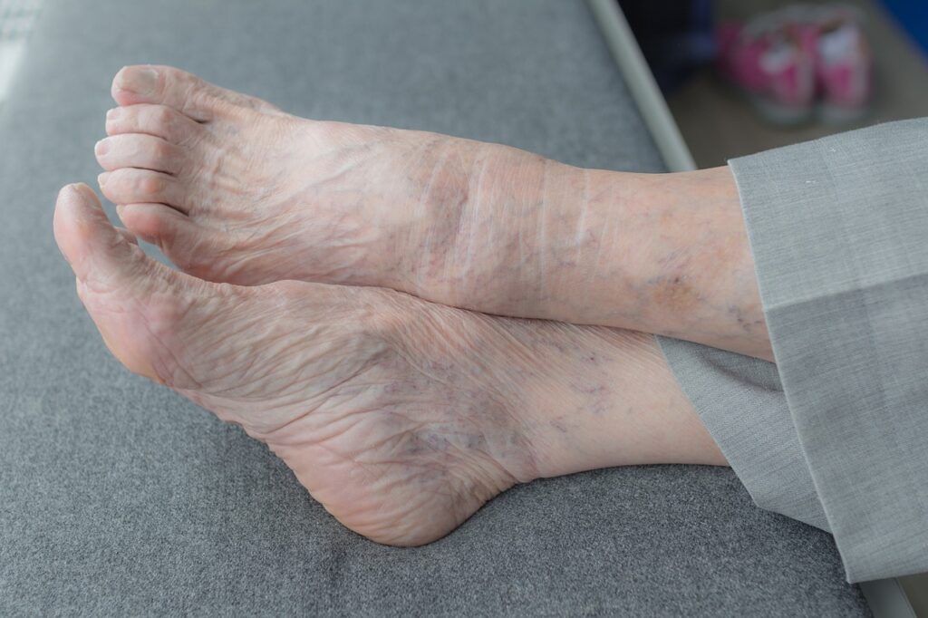 Comment en finir avec les pieds secs et crevassés ? Conseils pour femmes
